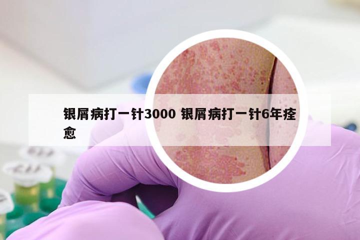 银屑病打一针3000 银屑病打一针6年痊愈
