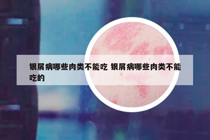 银屑病哪些肉类不能吃 银屑病哪些肉类不能吃的