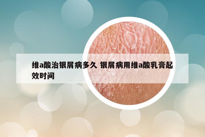 维a酸治银屑病多久 银屑病用维a酸乳膏起效时间