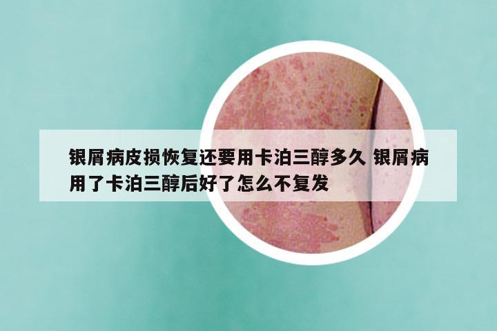 银屑病皮损恢复还要用卡泊三醇多久 银屑病用了卡泊三醇后好了怎么不复发