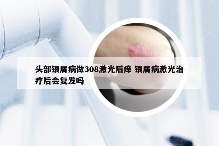 头部银屑病做308激光后痒 银屑病激光治疗后会复发吗
