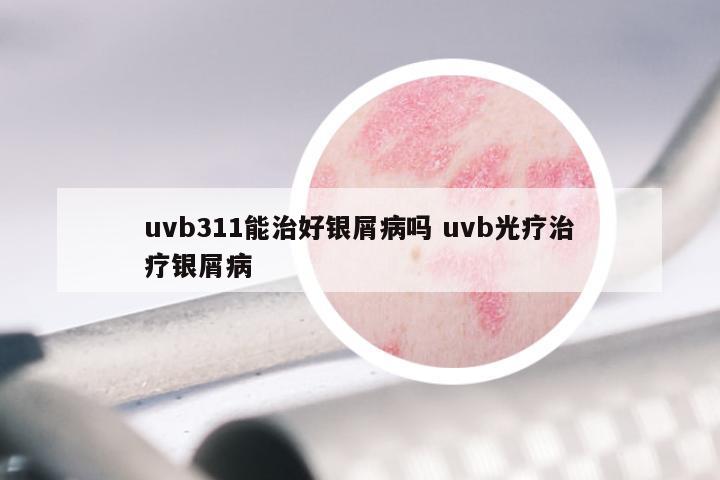 uvb311能治好银屑病吗 uvb光疗治疗银屑病