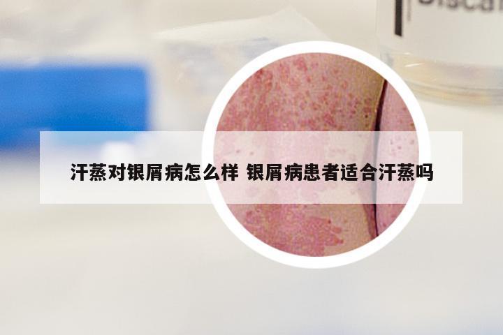 汗蒸对银屑病怎么样 银屑病患者适合汗蒸吗