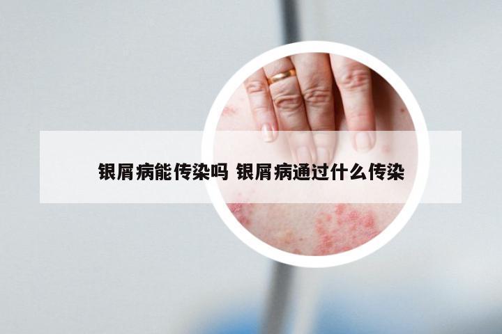 银屑病能传染吗 银屑病通过什么传染