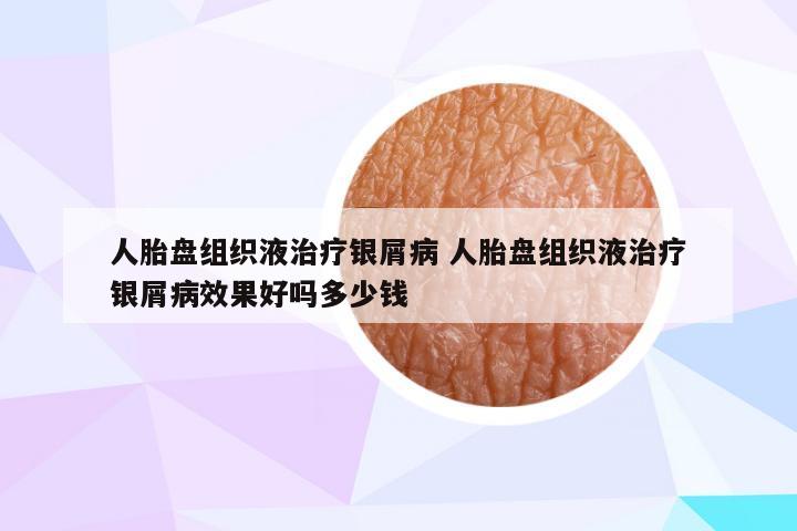 人胎盘组织液治疗银屑病 人胎盘组织液治疗银屑病效果好吗多少钱