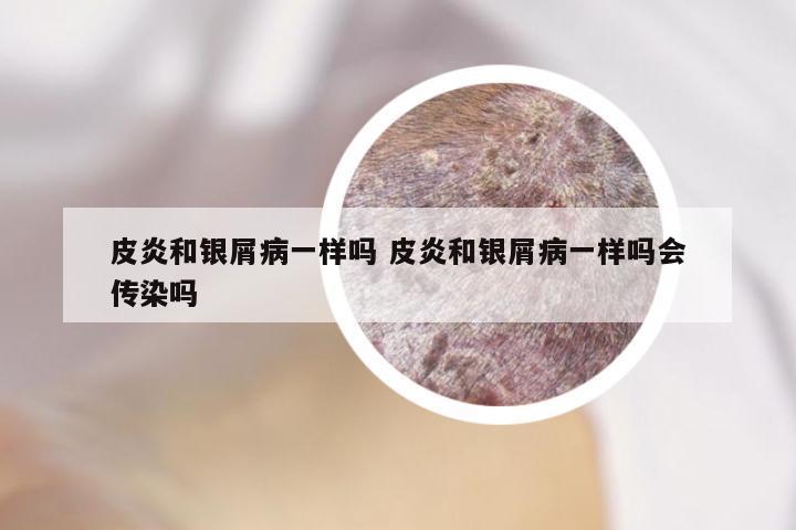 皮炎和银屑病一样吗 皮炎和银屑病一样吗会传染吗
