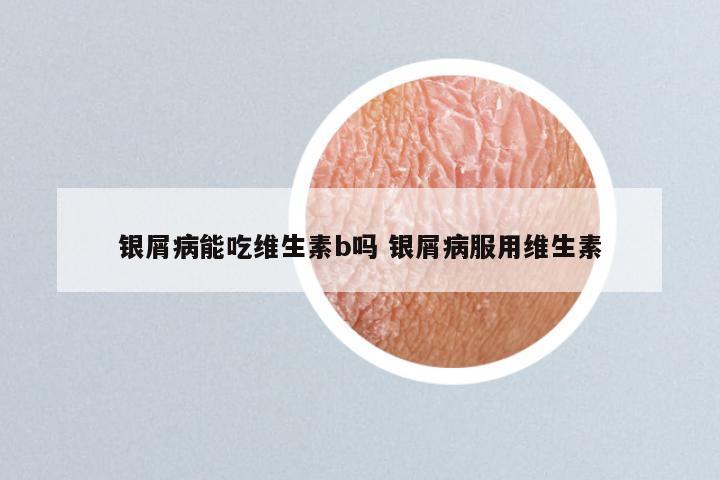 银屑病能吃维生素b吗 银屑病服用维生素