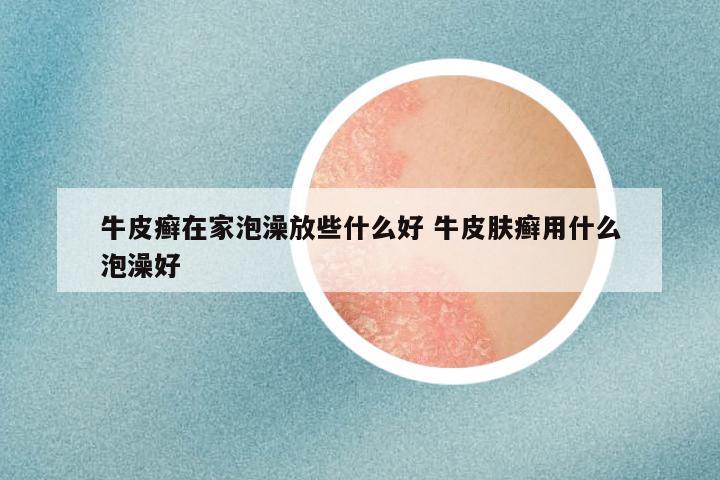 牛皮癣在家泡澡放些什么好 牛皮肤癣用什么泡澡好