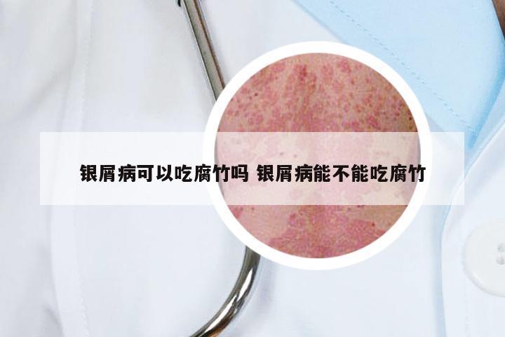 银屑病可以吃腐竹吗 银屑病能不能吃腐竹