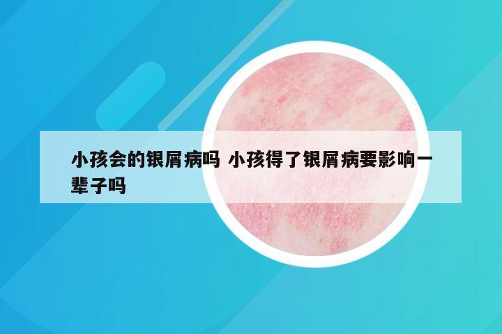 小孩会的银屑病吗 小孩得了银屑病要影响一辈子吗