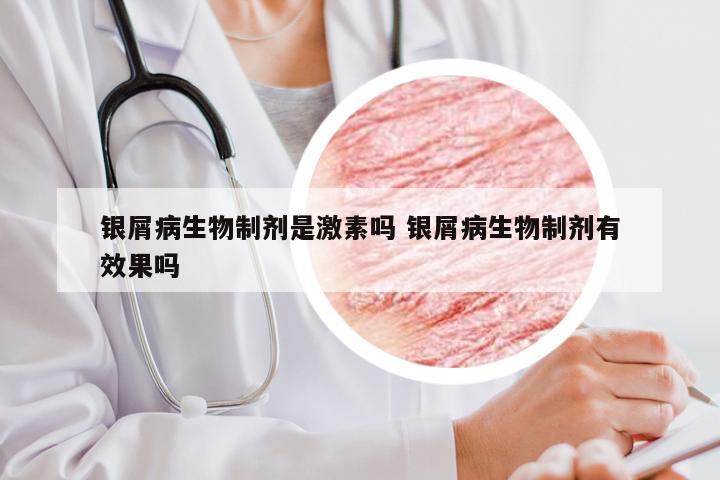 银屑病生物制剂是激素吗 银屑病生物制剂有效果吗