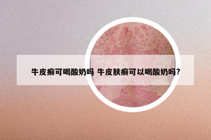 牛皮癣可喝酸奶吗 牛皮肤癣可以喝酸奶吗?