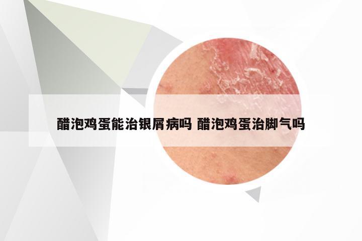 醋泡鸡蛋能治银屑病吗 醋泡鸡蛋治脚气吗