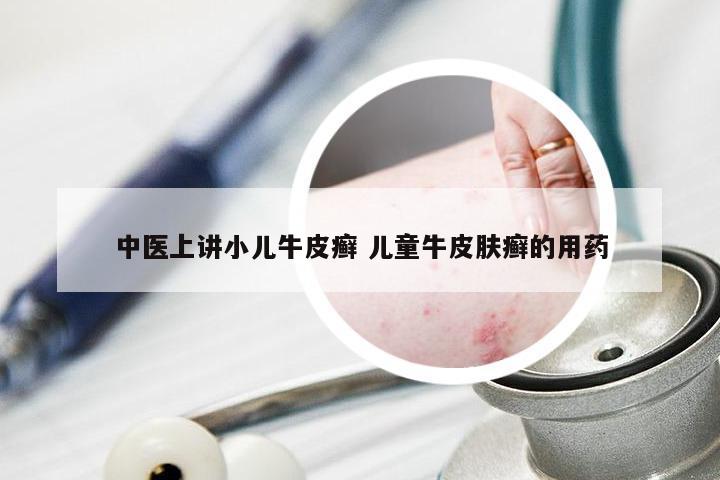 中医上讲小儿牛皮癣 儿童牛皮肤癣的用药