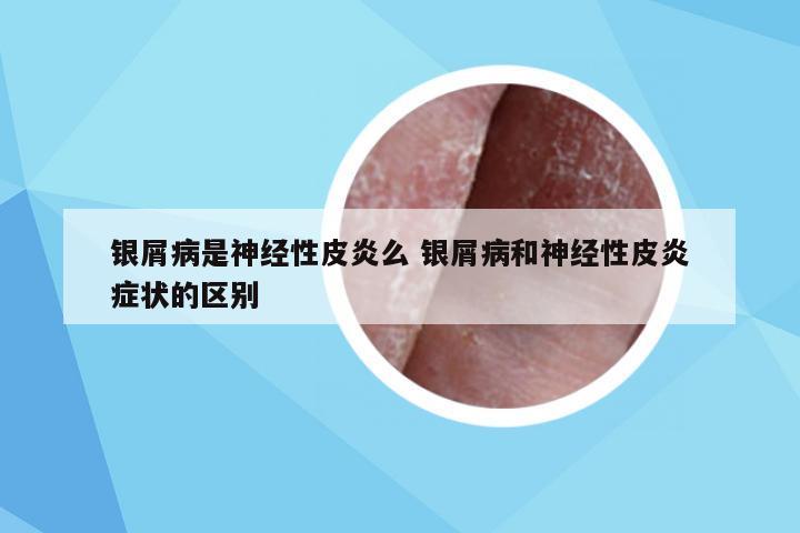 银屑病是神经性皮炎么 银屑病和神经性皮炎症状的区别