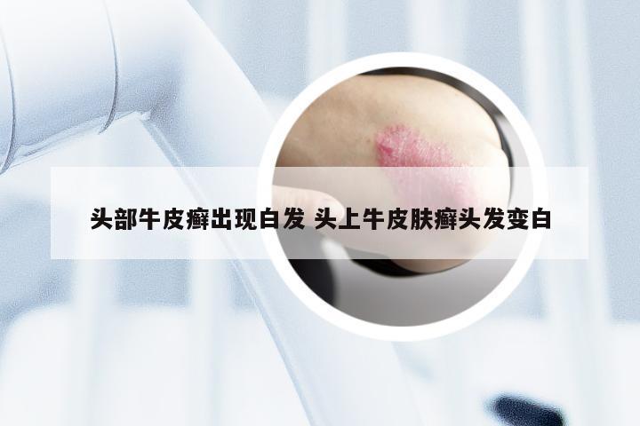 头部牛皮癣出现白发 头上牛皮肤癣头发变白