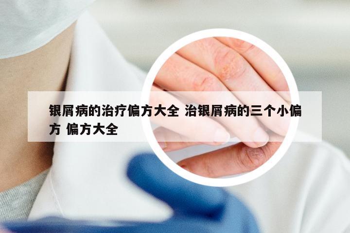 银屑病的治疗偏方大全 治银屑病的三个小偏方 偏方大全