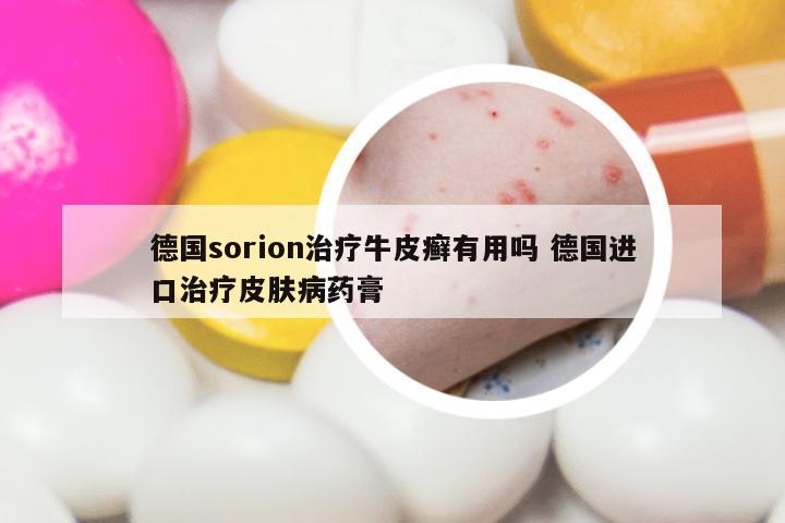 德国sorion治疗牛皮癣有用吗 德国进口治疗皮肤病药膏