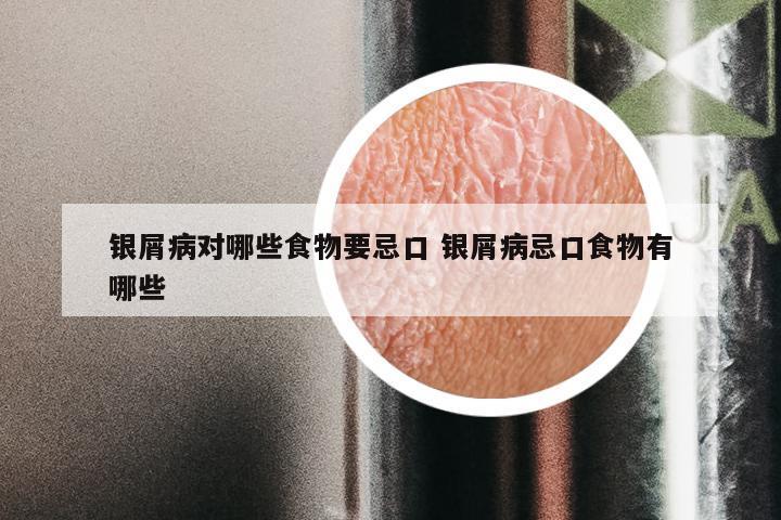 银屑病对哪些食物要忌口 银屑病忌口食物有哪些