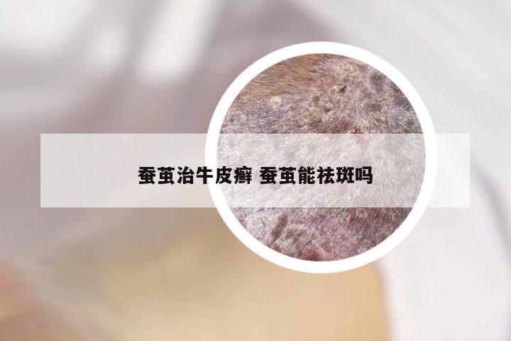 蚕茧治牛皮癣 蚕茧能祛斑吗