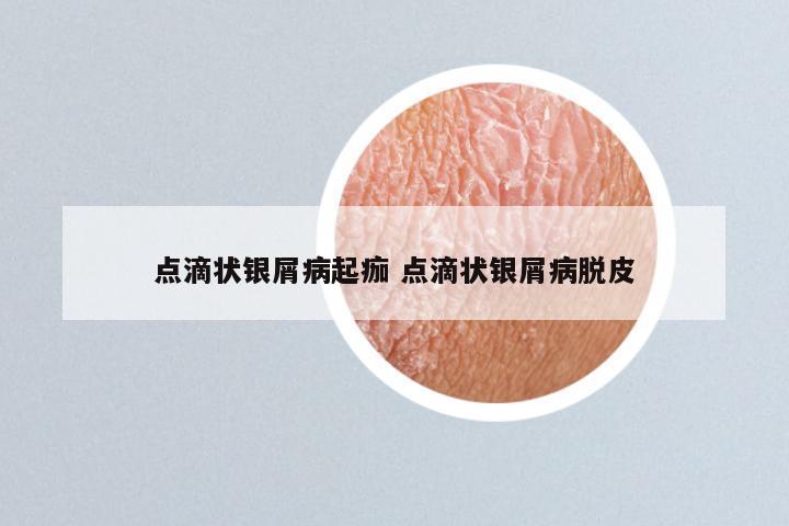 点滴状银屑病起痂 点滴状银屑病脱皮