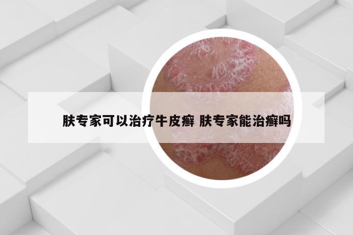 肤专家可以治疗牛皮癣 肤专家能治癣吗