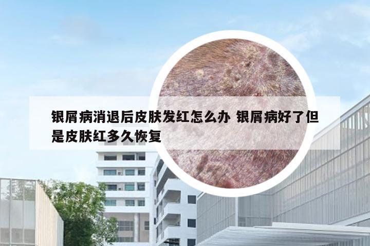 银屑病消退后皮肤发红怎么办 银屑病好了但是皮肤红多久恢复