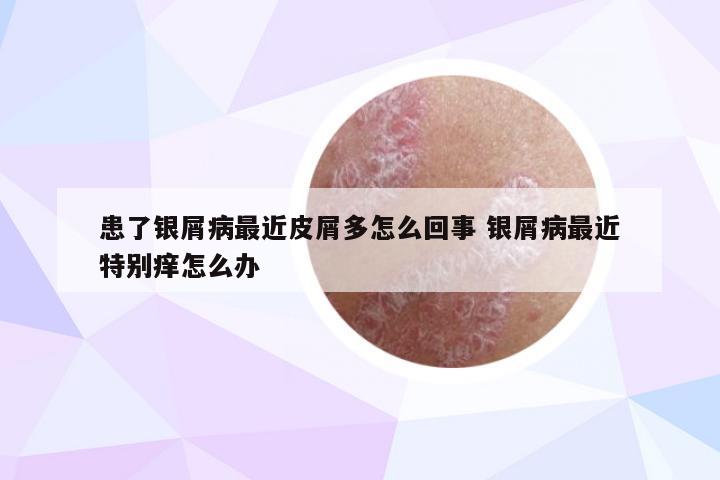 患了银屑病最近皮屑多怎么回事 银屑病最近特别痒怎么办