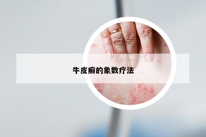 牛皮癣的象数疗法
