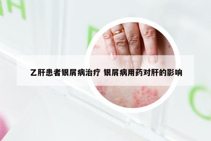 乙肝患者银屑病治疗 银屑病用药对肝的影响