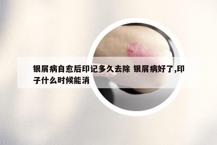 银屑病自愈后印记多久去除 银屑病好了,印子什么时候能消