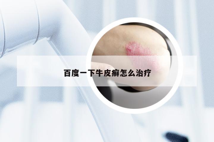 百度一下牛皮癣怎么治疗
