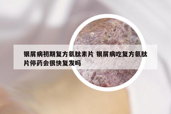 银屑病初期复方氨肽素片 银屑病吃复方氨肽片停药会很快复发吗