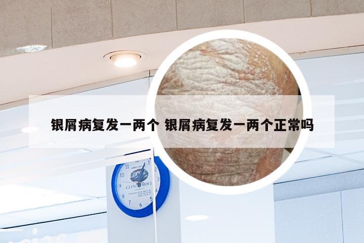 银屑病复发一两个 银屑病复发一两个正常吗