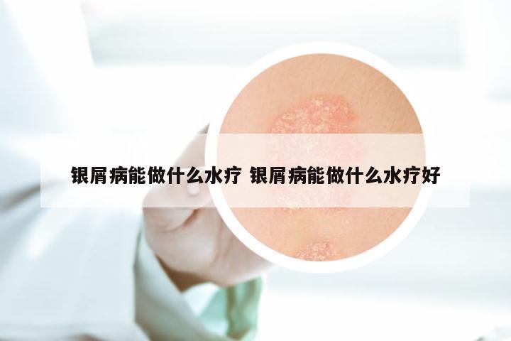银屑病能做什么水疗 银屑病能做什么水疗好