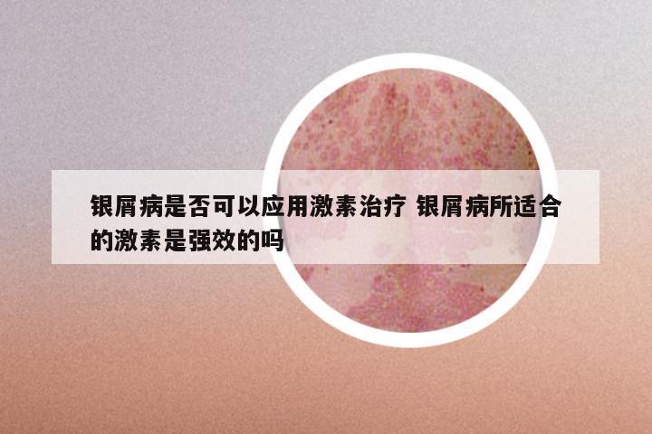 银屑病是否可以应用激素治疗 银屑病所适合的激素是强效的吗