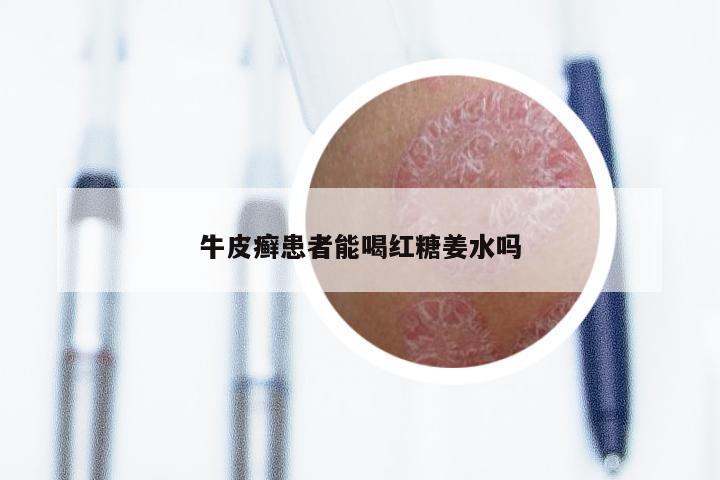 牛皮癣患者能喝红糖姜水吗