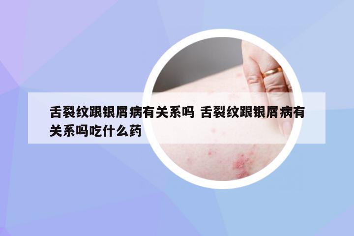 舌裂纹跟银屑病有关系吗 舌裂纹跟银屑病有关系吗吃什么药