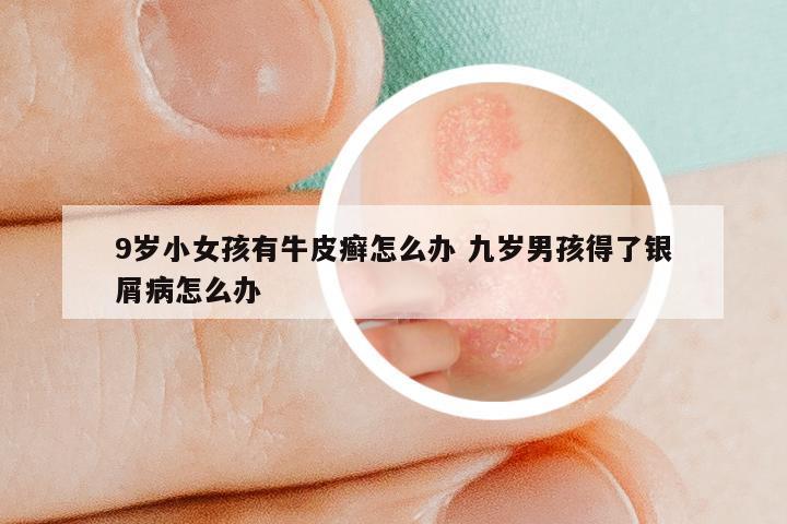 9岁小女孩有牛皮癣怎么办 九岁男孩得了银屑病怎么办