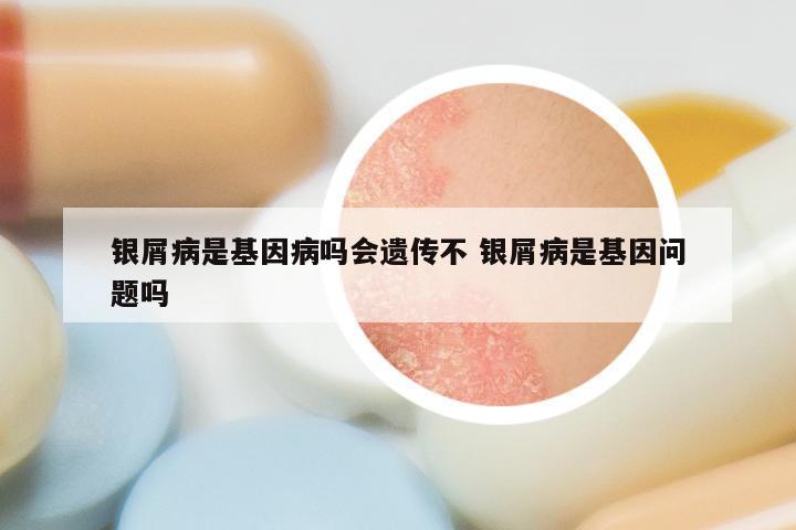 银屑病是基因病吗会遗传不 银屑病是基因问题吗