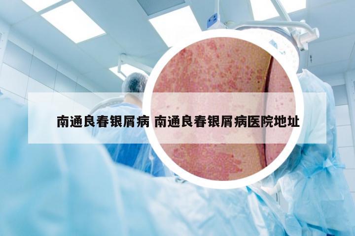 南通良春银屑病 南通良春银屑病医院地址