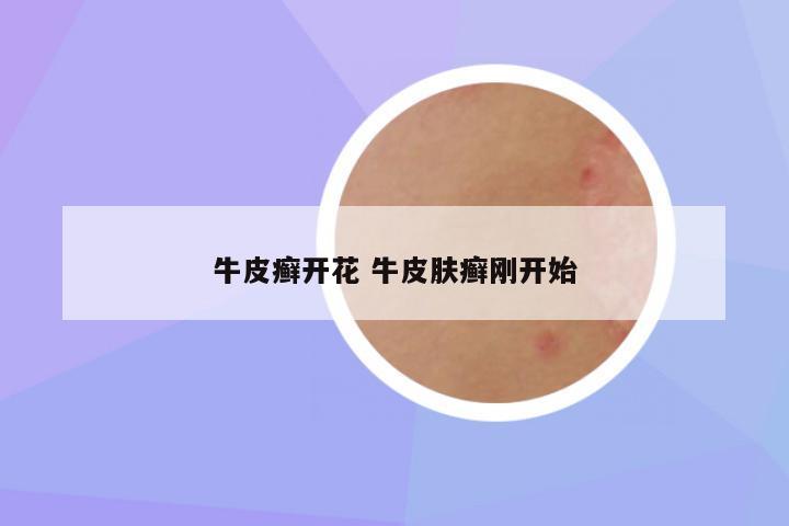牛皮癣开花 牛皮肤癣刚开始
