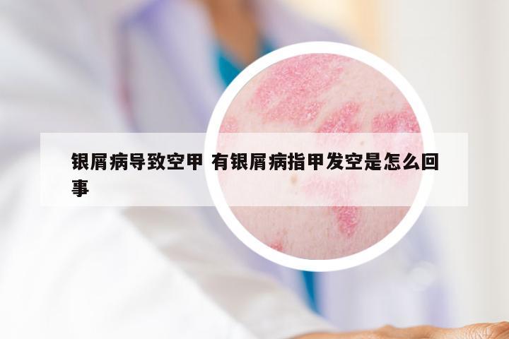 银屑病导致空甲 有银屑病指甲发空是怎么回事