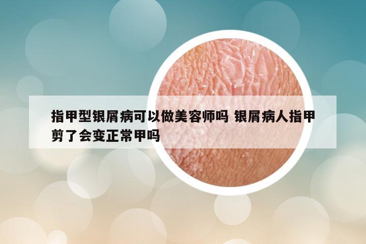 指甲型银屑病可以做美容师吗 银屑病人指甲剪了会变正常甲吗