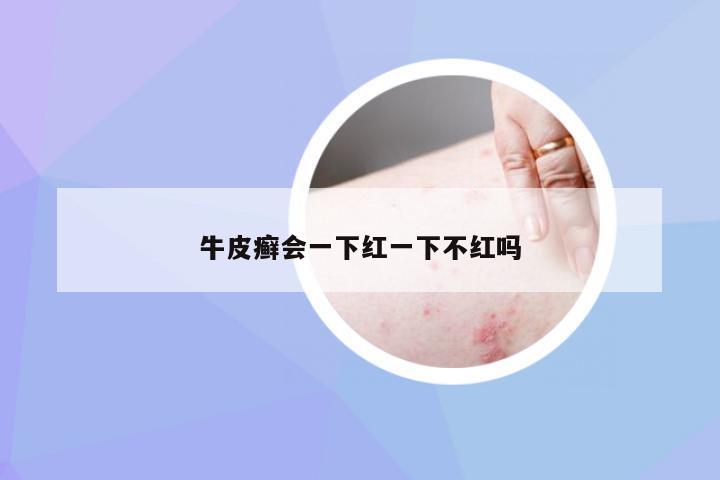 牛皮癣会一下红一下不红吗