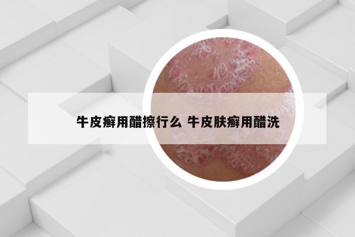 牛皮癣用醋擦行么 牛皮肤癣用醋洗