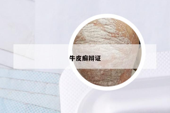 牛皮癣辩证