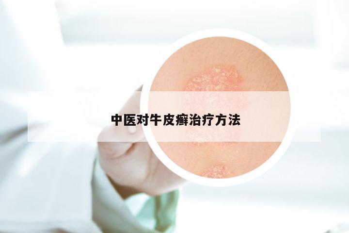 中医对牛皮癣治疗方法