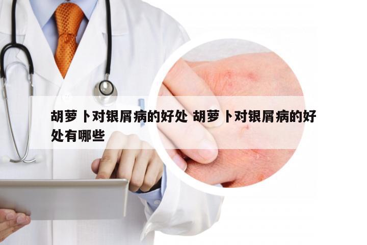 胡萝卜对银屑病的好处 胡萝卜对银屑病的好处有哪些