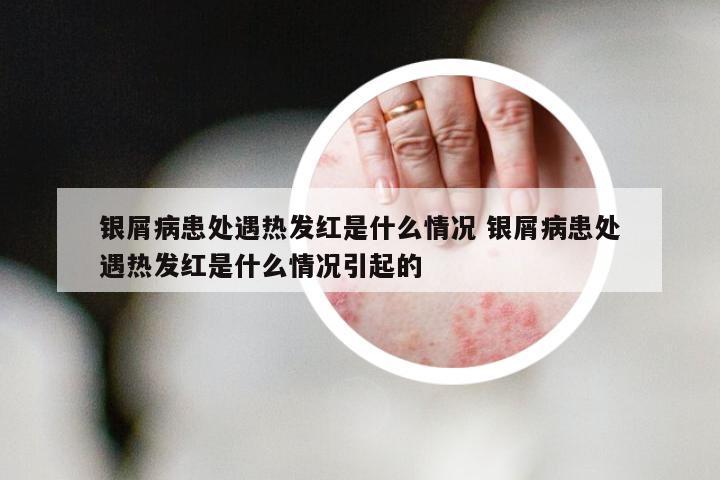 银屑病患处遇热发红是什么情况 银屑病患处遇热发红是什么情况引起的